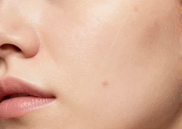 Acne After Treatment