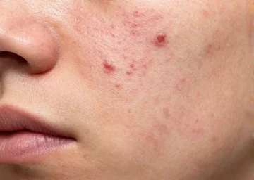 Acne Before Treatment