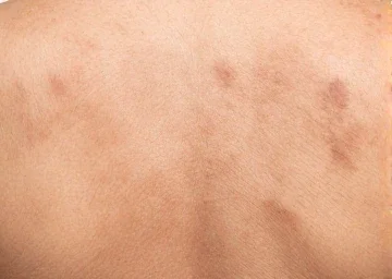 Pigmentation Treatment Satara